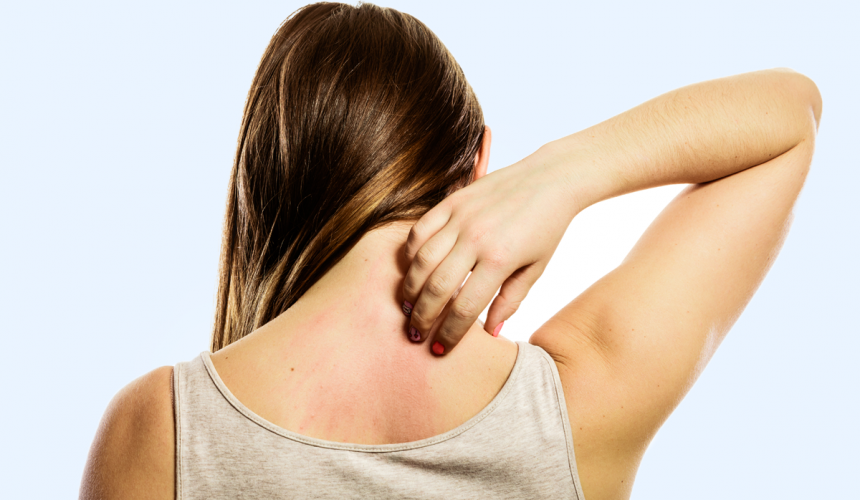 Dermatite de contato: causas e tratamento Dermatite de contato: causas e tratamento