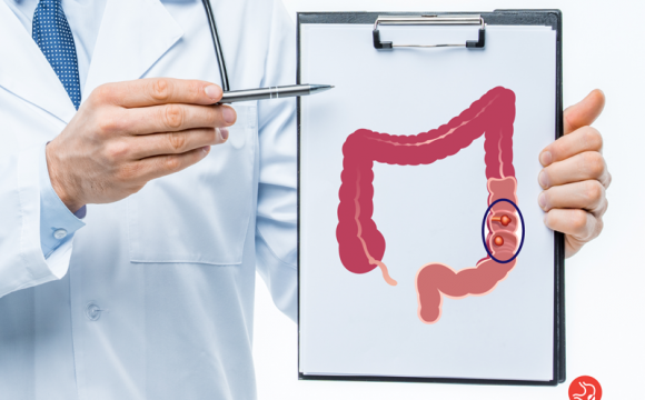 Câncer de Intestino: conheça os fatores de risco, sintomas, prevenção e tratamento